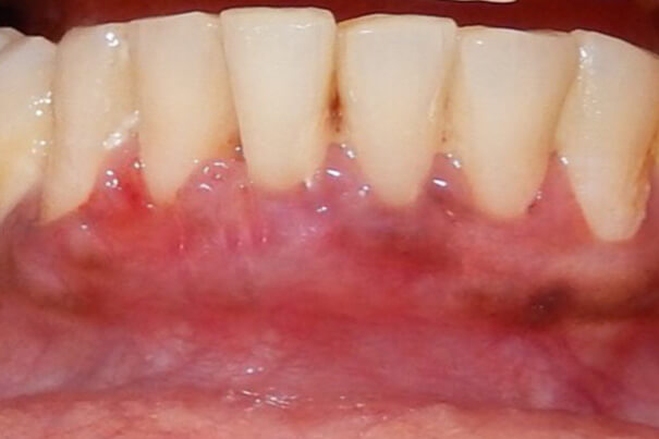 After gingival recession 